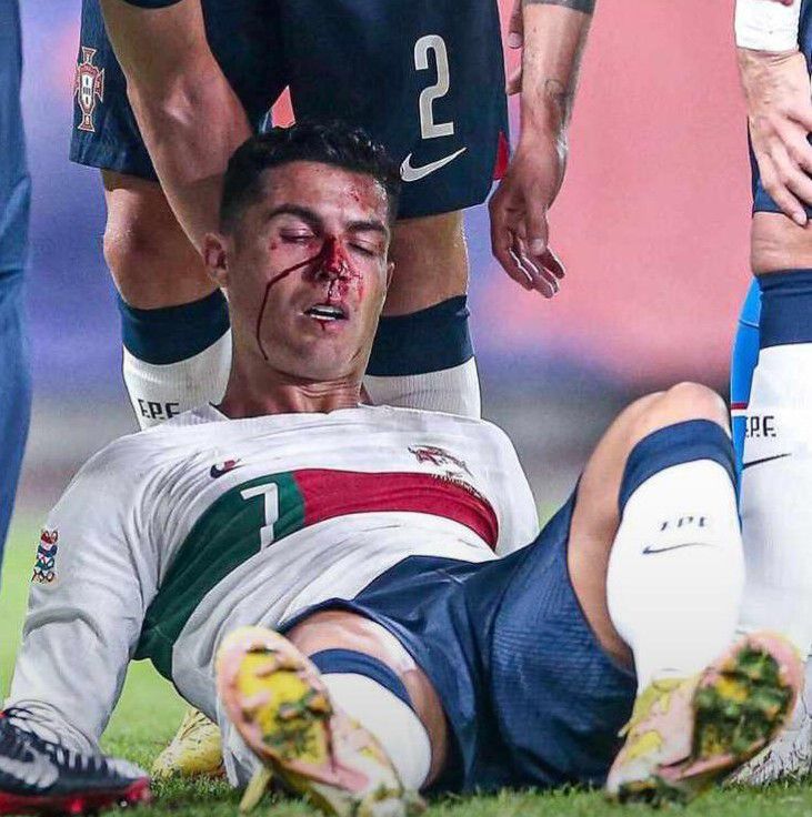 Ronaldo vẫn tích cực tập luyện dù bị bầm mặt